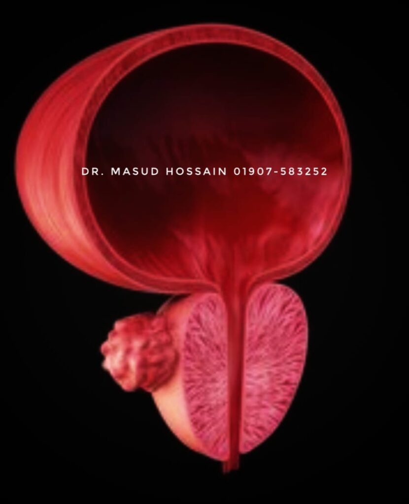Prostate Gland- প্রোস্টেট গ্ল্যান্ড এর হোমিও চিকিৎসা কী? 3 Prostate Gland- প্রোস্টেট গ্ল্যান্ড এর হোমিও চিকিৎসা কী?
