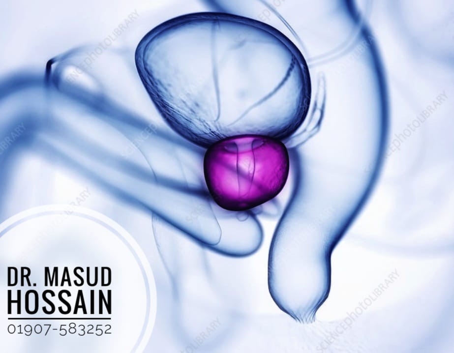 Prostate Gland- প্রোস্টেট গ্ল্যান্ড এর হোমিও চিকিৎসা কী? 5 Prostate Gland- প্রোস্টেট গ্ল্যান্ড এর হোমিও চিকিৎসা কী?