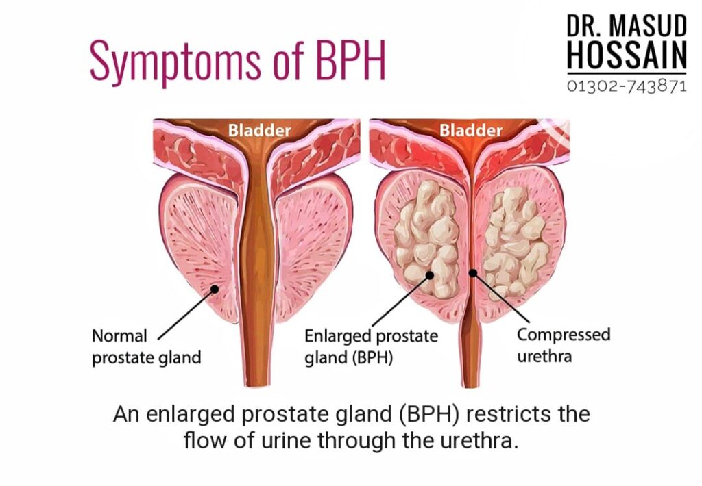 Prostatic hyperplasia কি? 3 Prostatic hyperplasia কি?