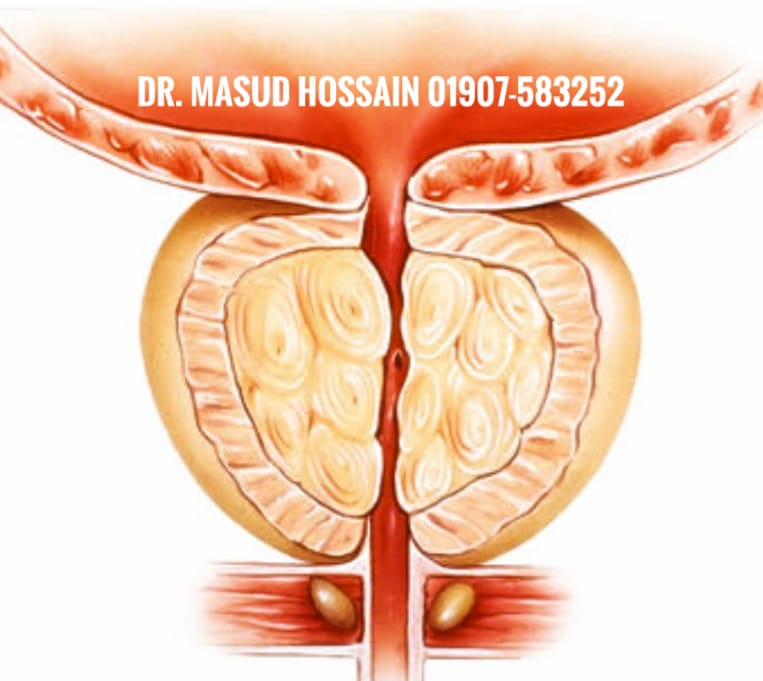 Prostatic hyperplasia কি? 4 Prostatic hyperplasia কি?
